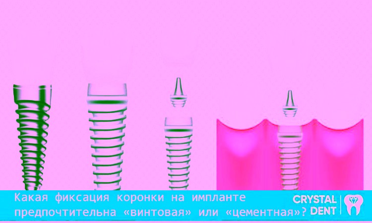 Порівняння цементної і гвинтової фіксації коронок на імплантатах