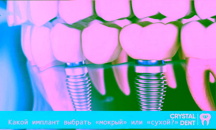Какой имплант выбрать “мокрый” или “сухой”?