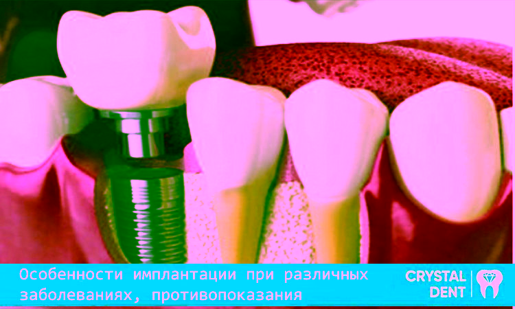 Особливості імплантації при різних захворюваннях – протипоказання