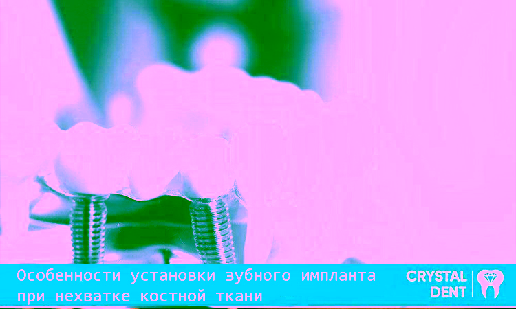 Особенности установки зубного импланта при нехватке костной ткани