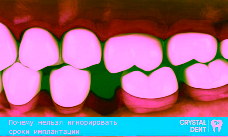 Чому не можна ігнорувати терміни імплантації