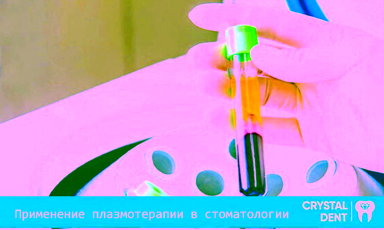 Застосування плазмотерапіі в стоматології