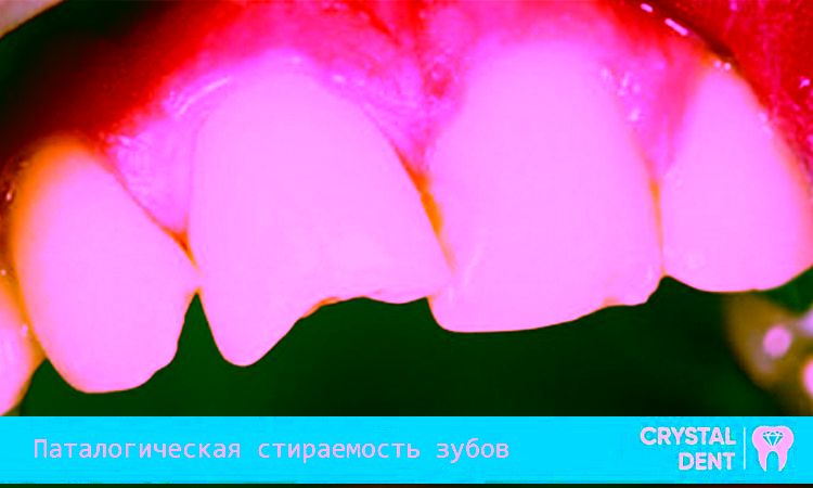 Патологическая стираемость зубов – опасность и терапия