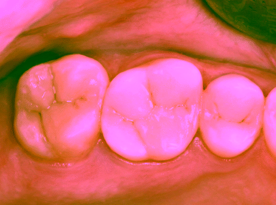 Artistic restoration of chewing teeth