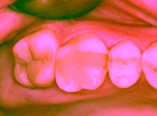 Artistic restoration of chewing teeth